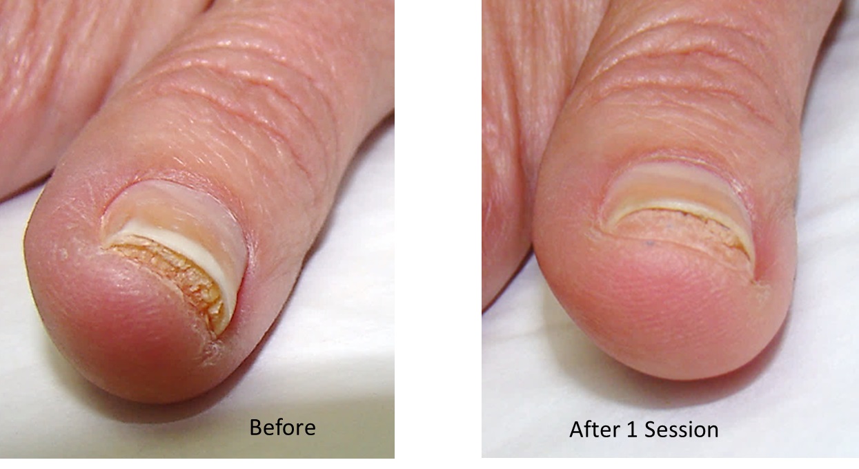 Laser Therapy for Nail Fungus* Canadian Optic & Laser Rejuvenation